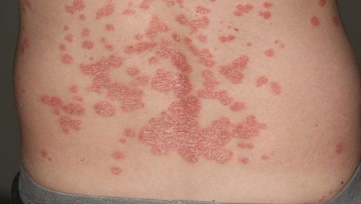 Cilt Hastalıkları Çeşitleri Türleri ve Özellikleri